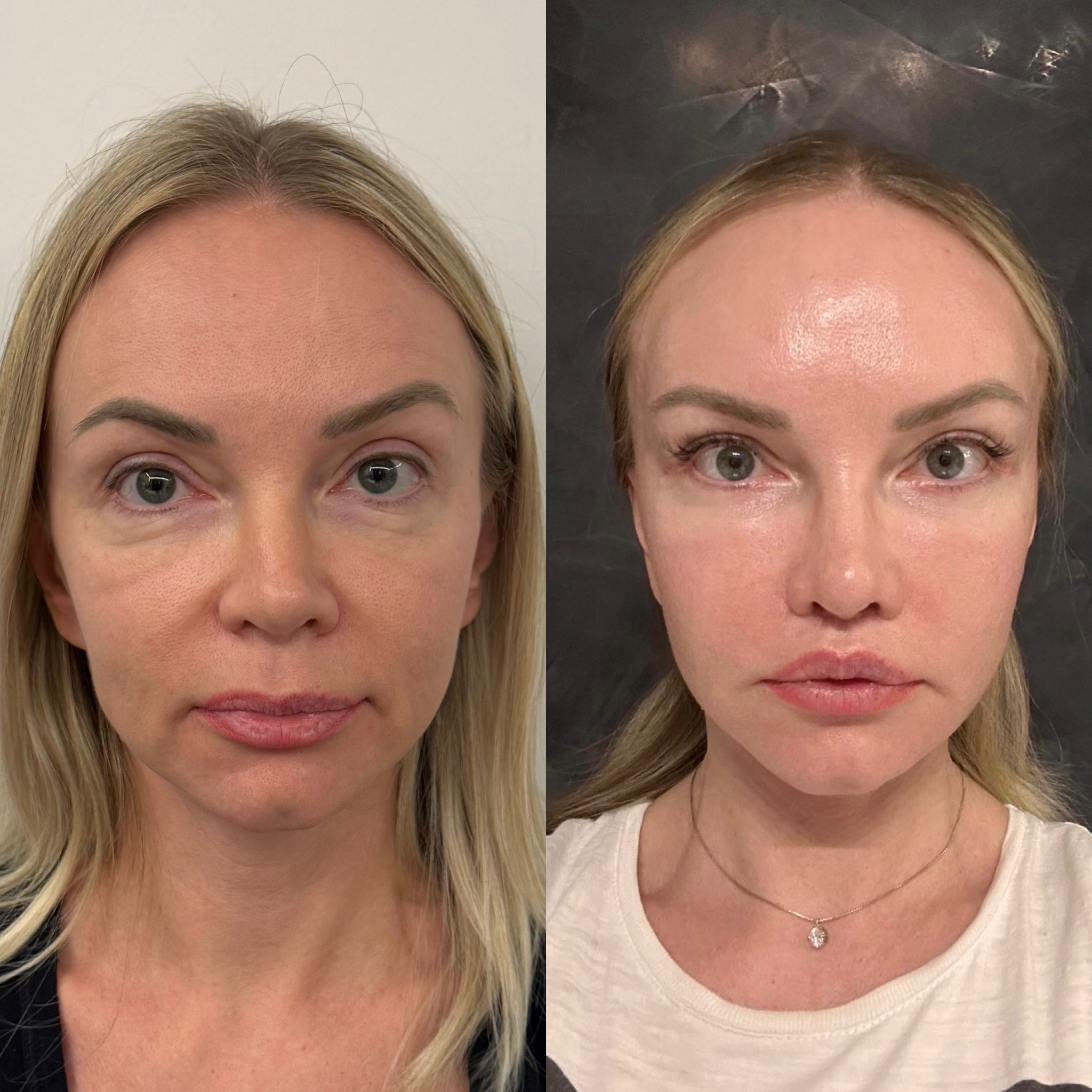 1 month post-op result of deep plane face lift without makeup before after photo