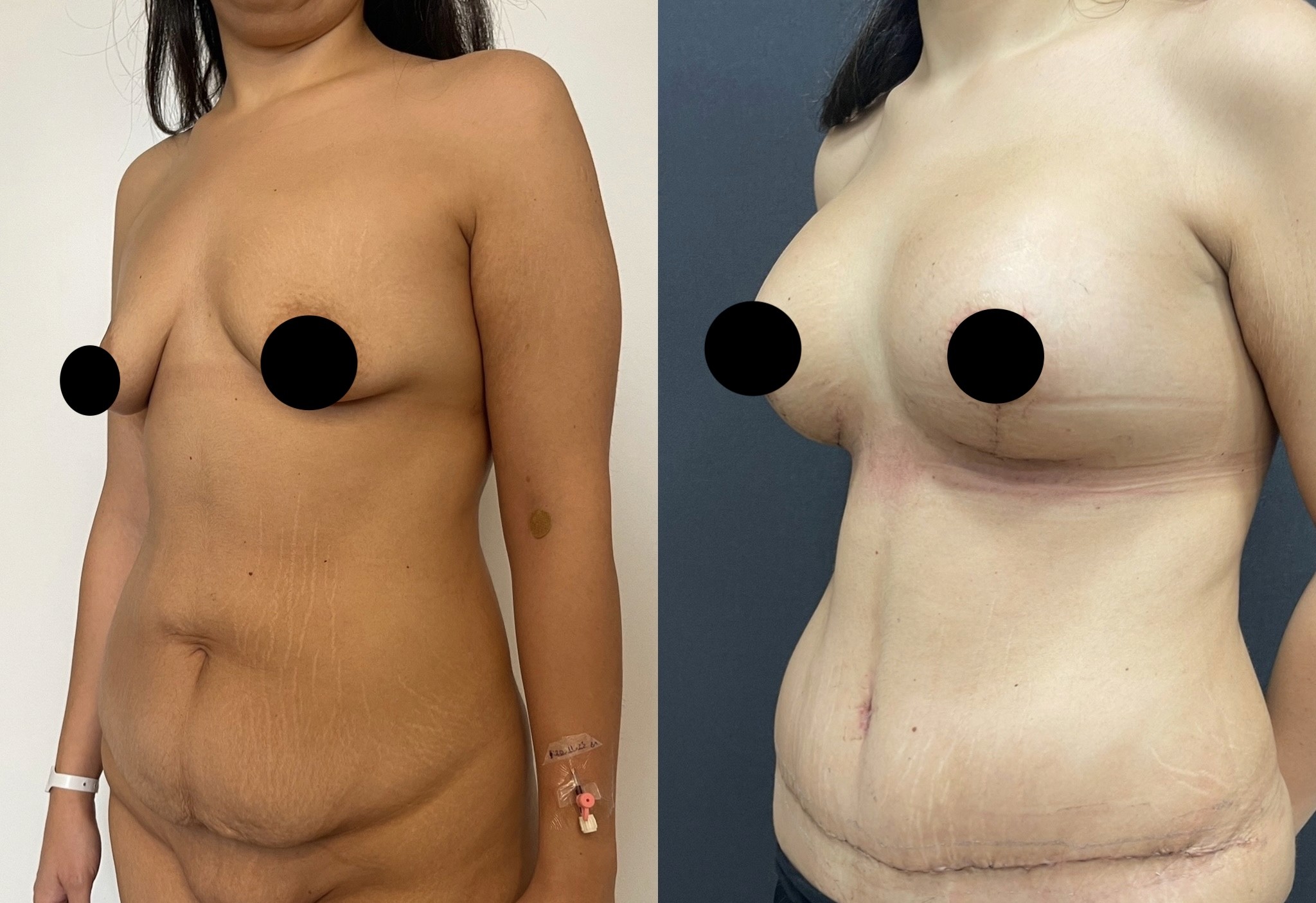 15 days post-op mommy makeover before after tuberous breast correction with breast lift implant and tummy tuck2