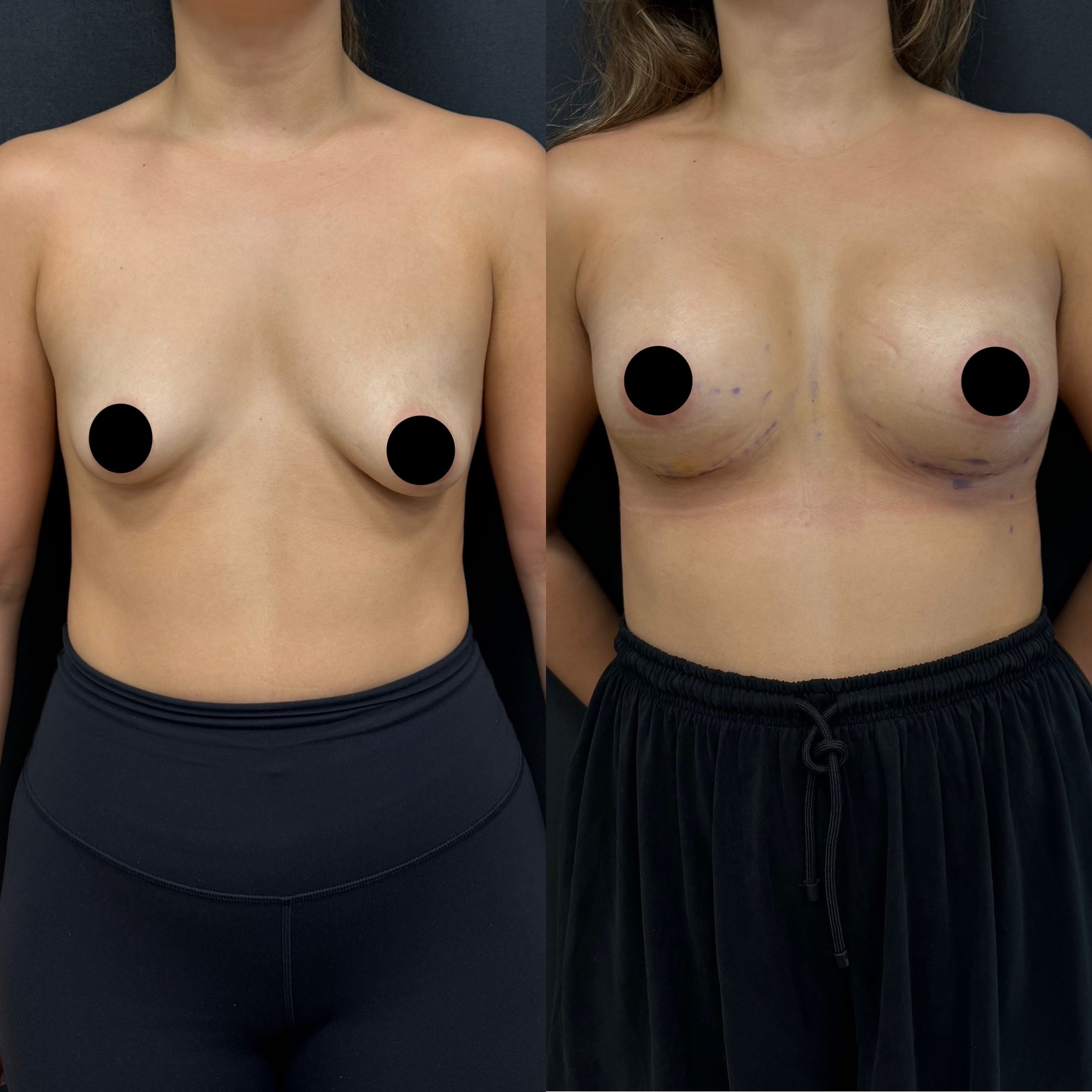 3 days post op result of asymmetrical breast implant surgery