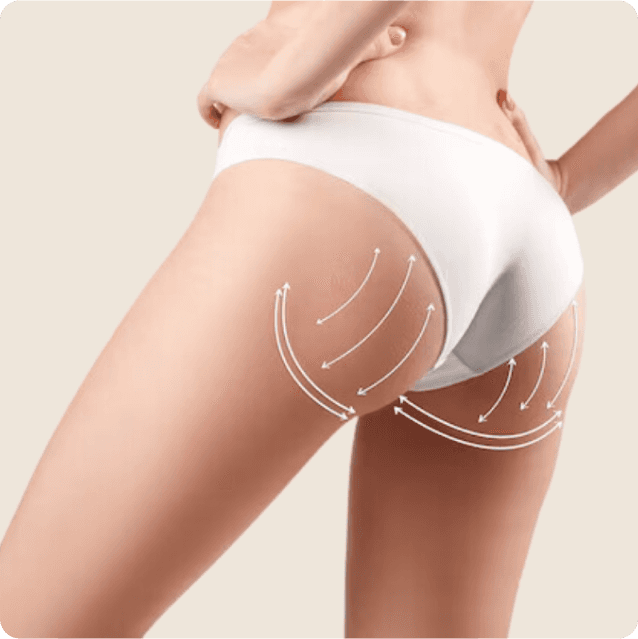 Close-up view of a person's buttocks after augmentation, showing a fuller, sculpted appearance achieved through implants or fat transfer. The individual has smooth skin and enhanced curves, with a noticeable increase in volume and shape, highlighting the results of the procedure.