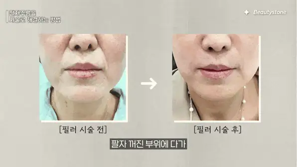 보톡스 대신 쥬베룩? 팔자주름 유형별 시술 가이드
