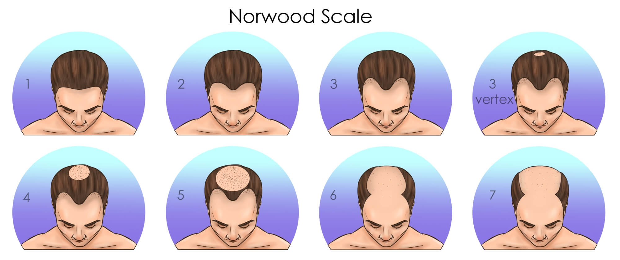 This hairhealth.ai image explains the Norwood scale of baldness 