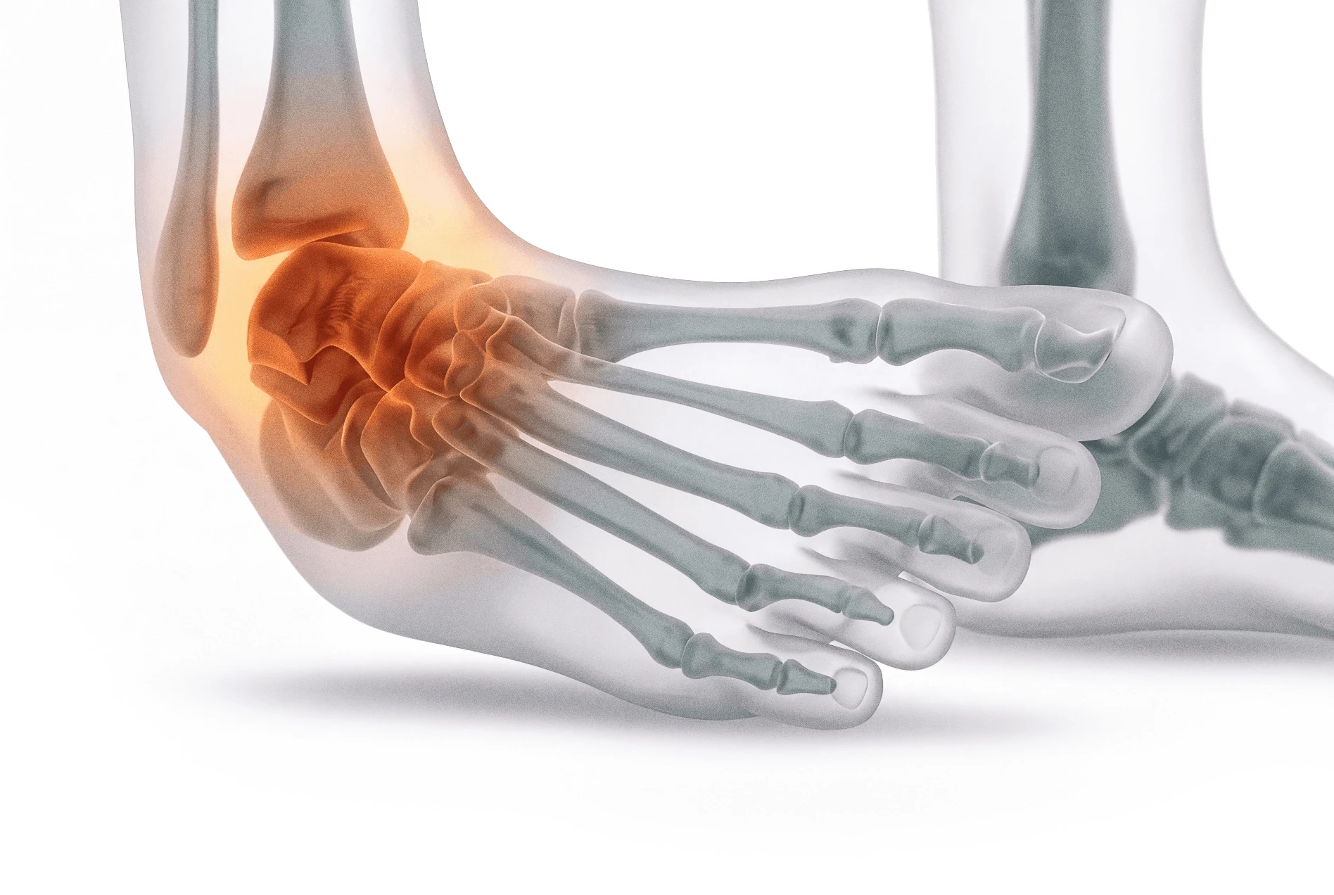 Child Recurrent Ankle Sprains