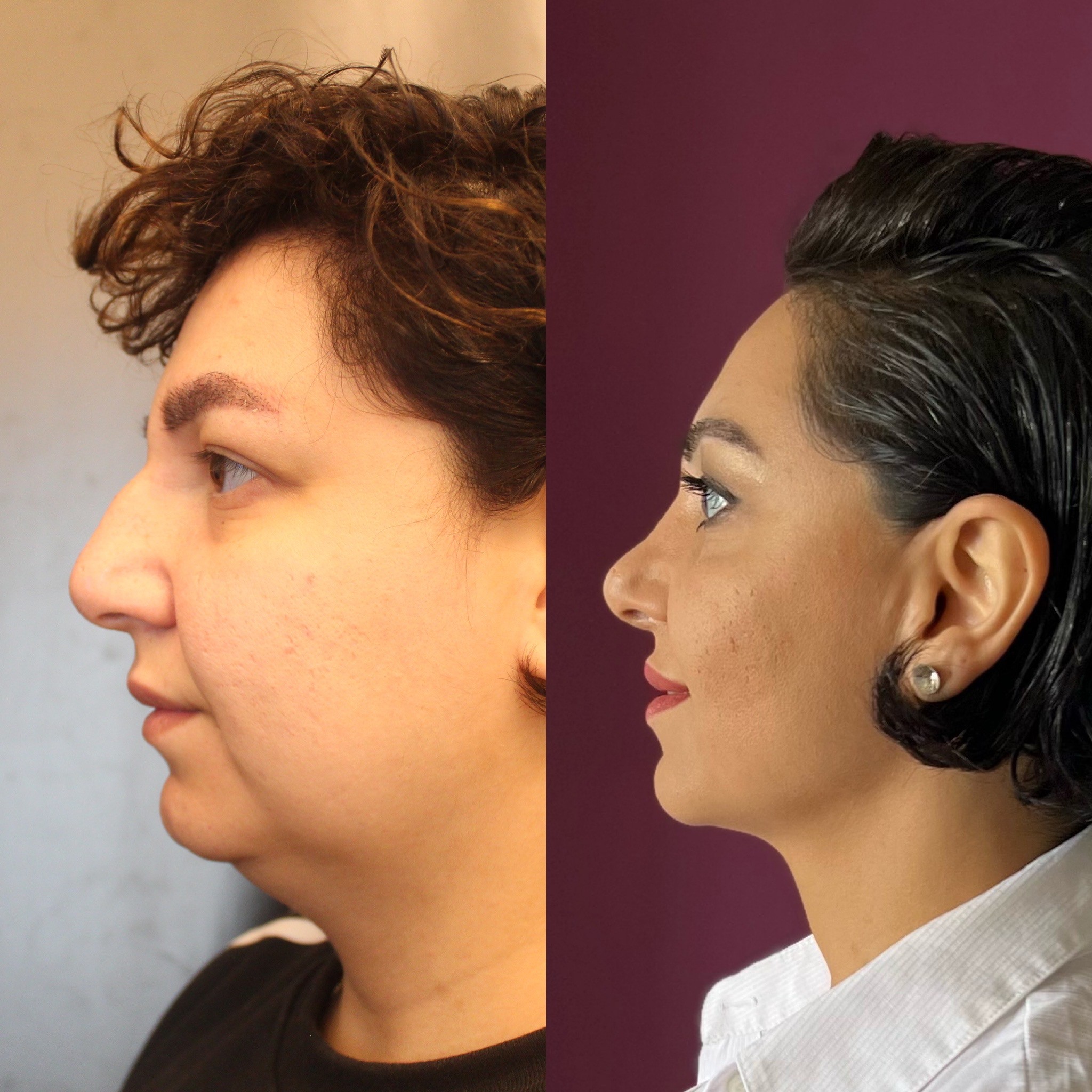 10 months post-op result buccal fat removal chin liposuction