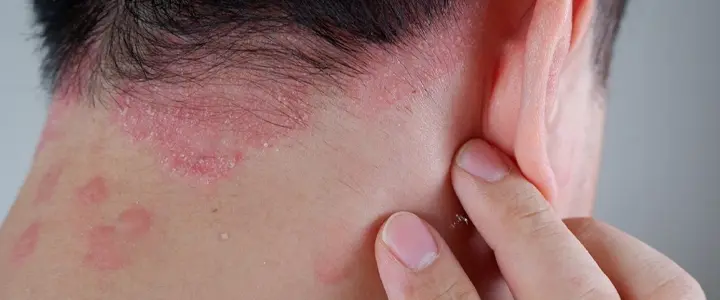 Oily, flaky patches on scalp, eyebrows, nose creases, or behind ears