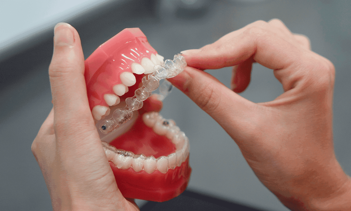 Hender som viser hvordan en usynlig tannregulering settes på en tannsmodell hos tannlege.