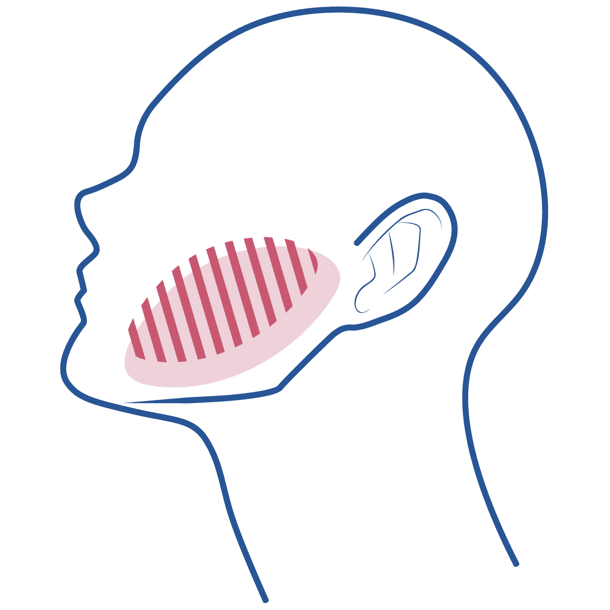 Ilustração de uma cabeça em perfil, vista de lado, desenhada com listras azuis e uma região marcada em rosa escuro, ilustrando a região da neuralgia do trigêmeo.