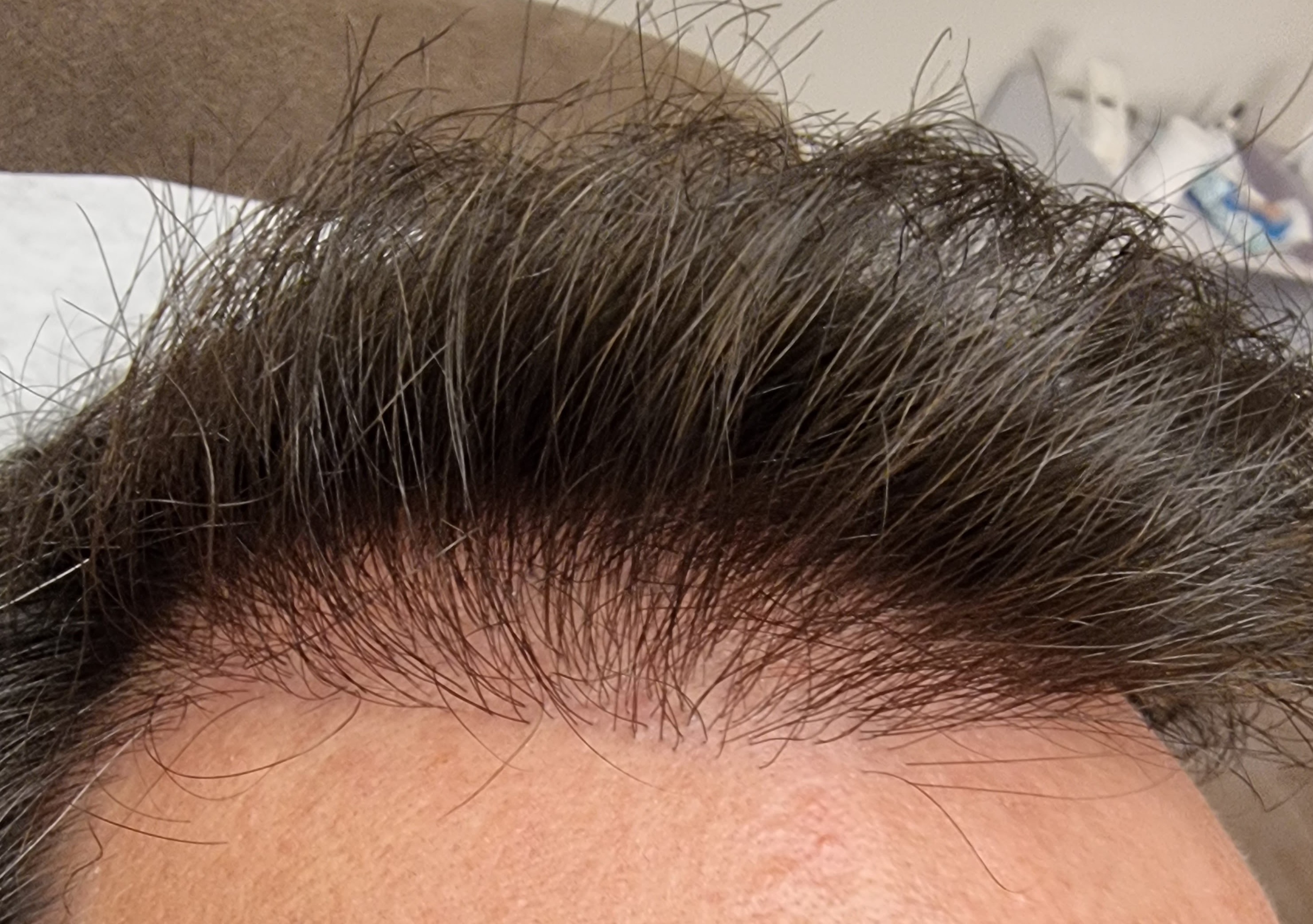 haarlijn reconstructie - els met klant