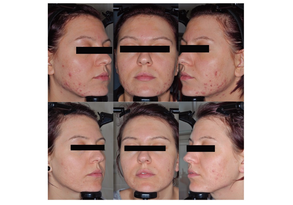 Acne Treatment Based on Selective Photothermolysis of Sebaceous Follicles with Topically Delivered Light-Absorbing Gold Microparticles