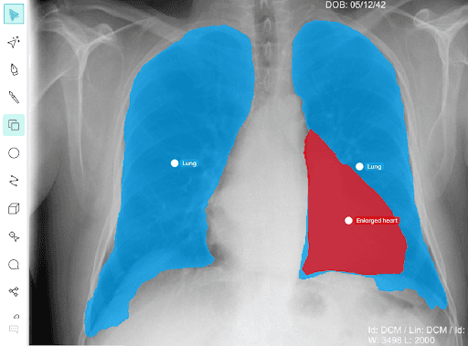 Lung segmentation performed using V7