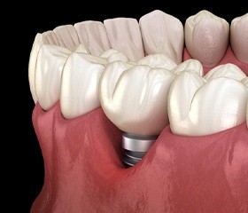 failed dental implant