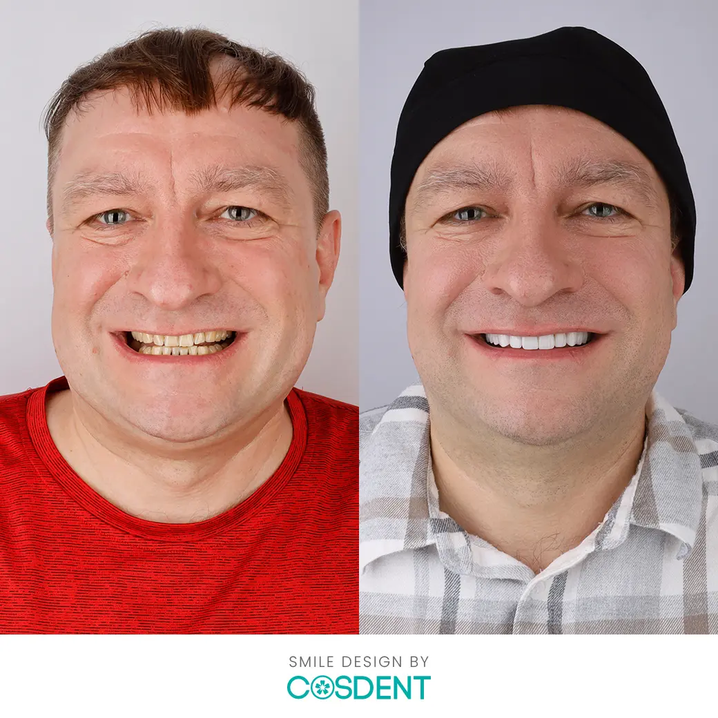คุณมาเชลล์ befor and after ออกแบบรอยยิ้มวีเนียร์ cosdent smile design