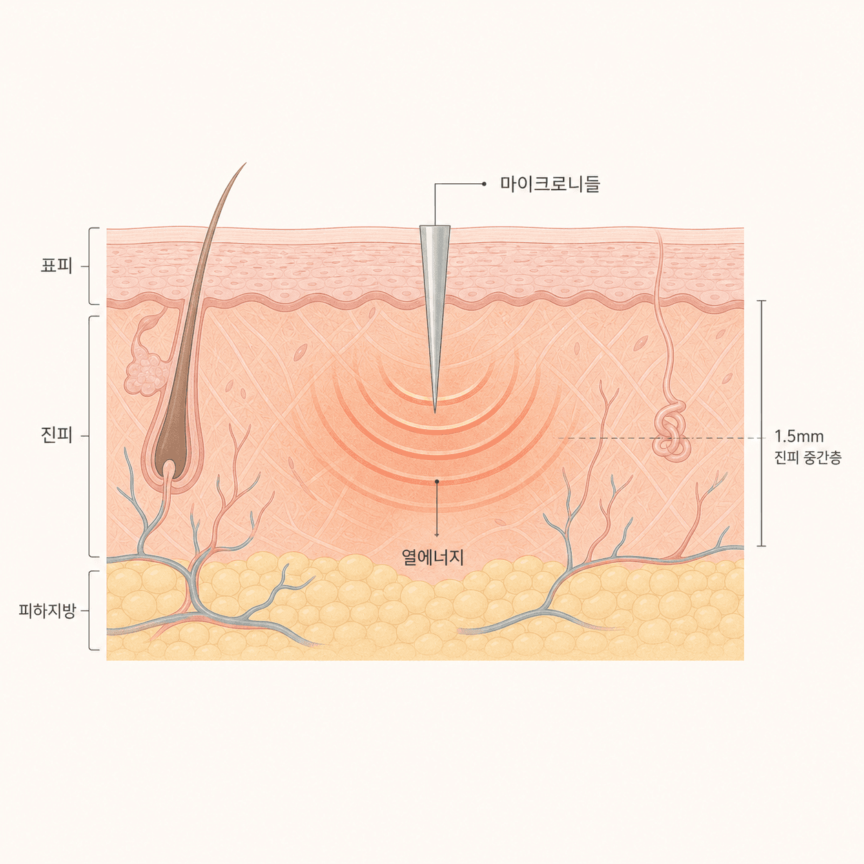 마이크로니들에서 방출된 고주파 에너지가 진피층에 열을 전달하는 경로
