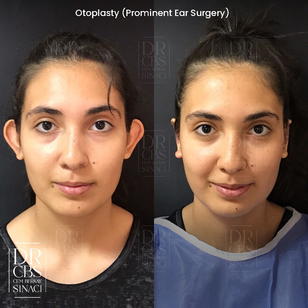 1st day before after prominent ear otoplasty 