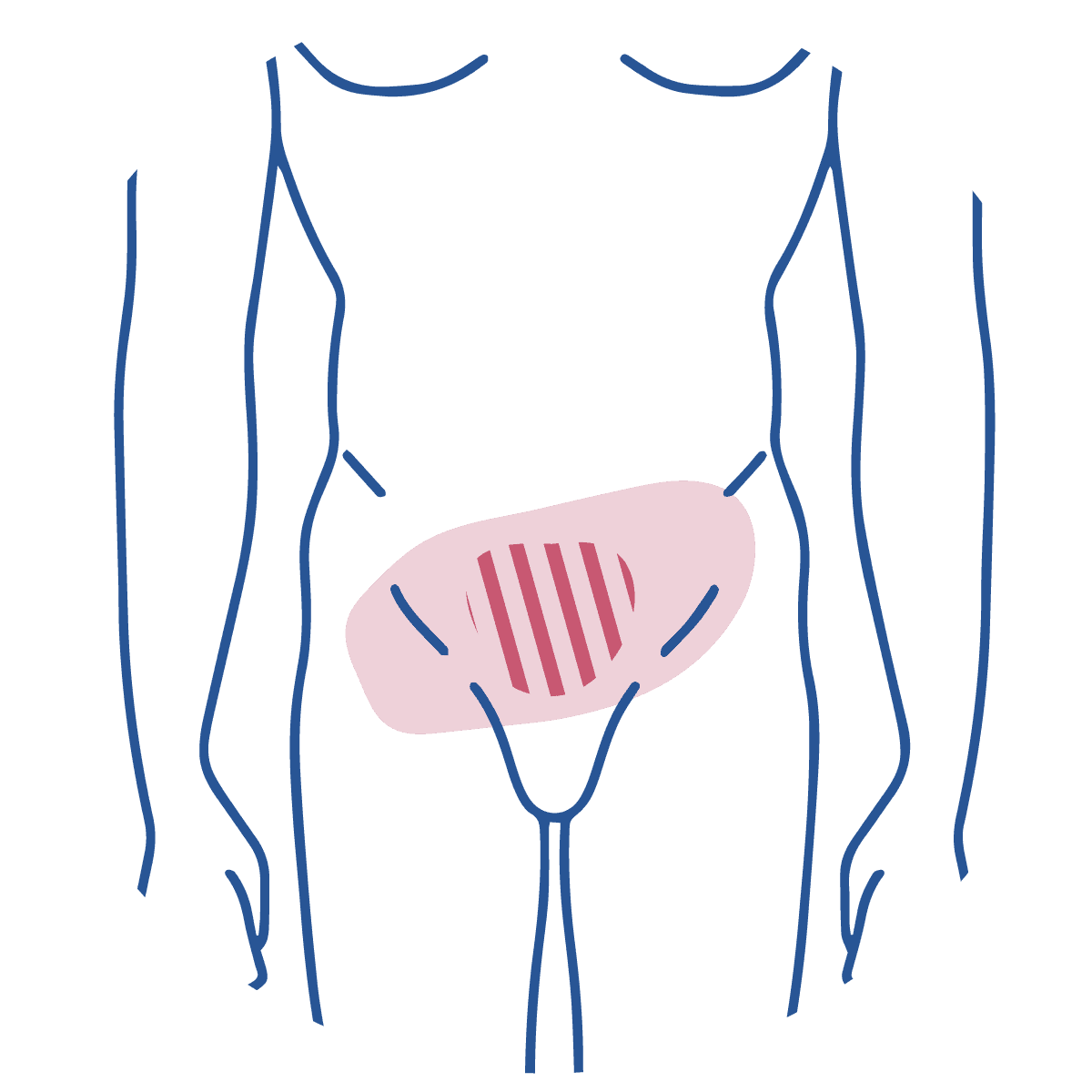 Ilustração mostra um homem de pé, desenhado com traços azuis, com uma mancha rajada em rosa escuro para ilustrar a reggião da incontinência.