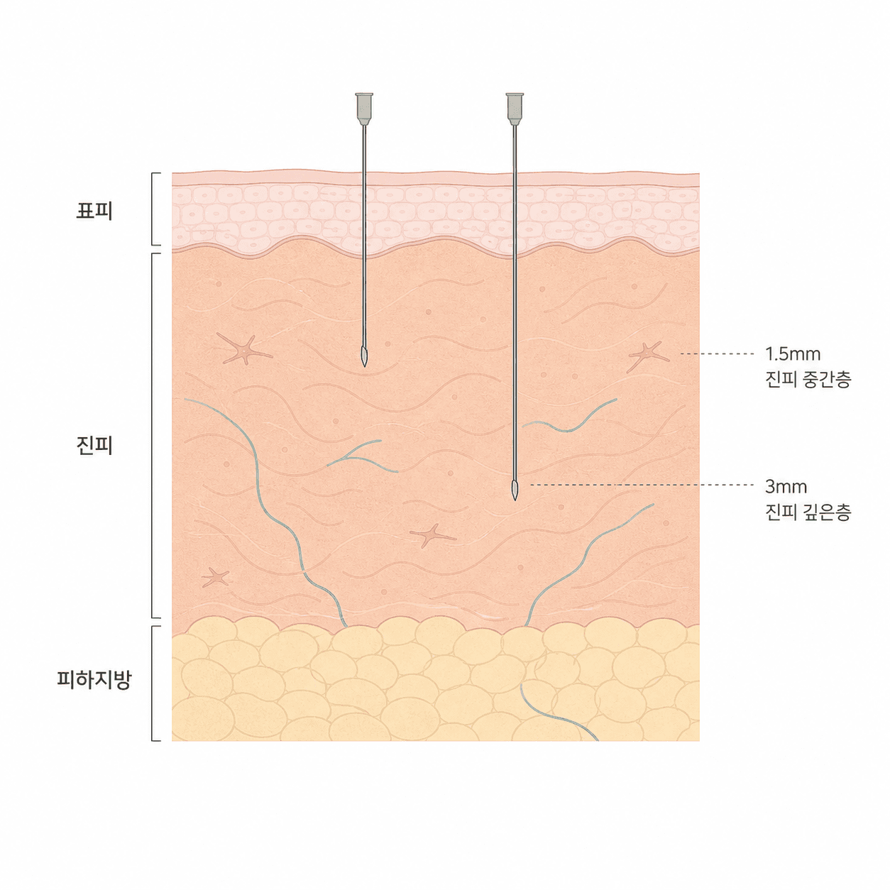 표피와 진피, 주입 깊이가 갈리는 자리
