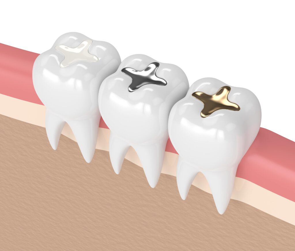 denta fillings