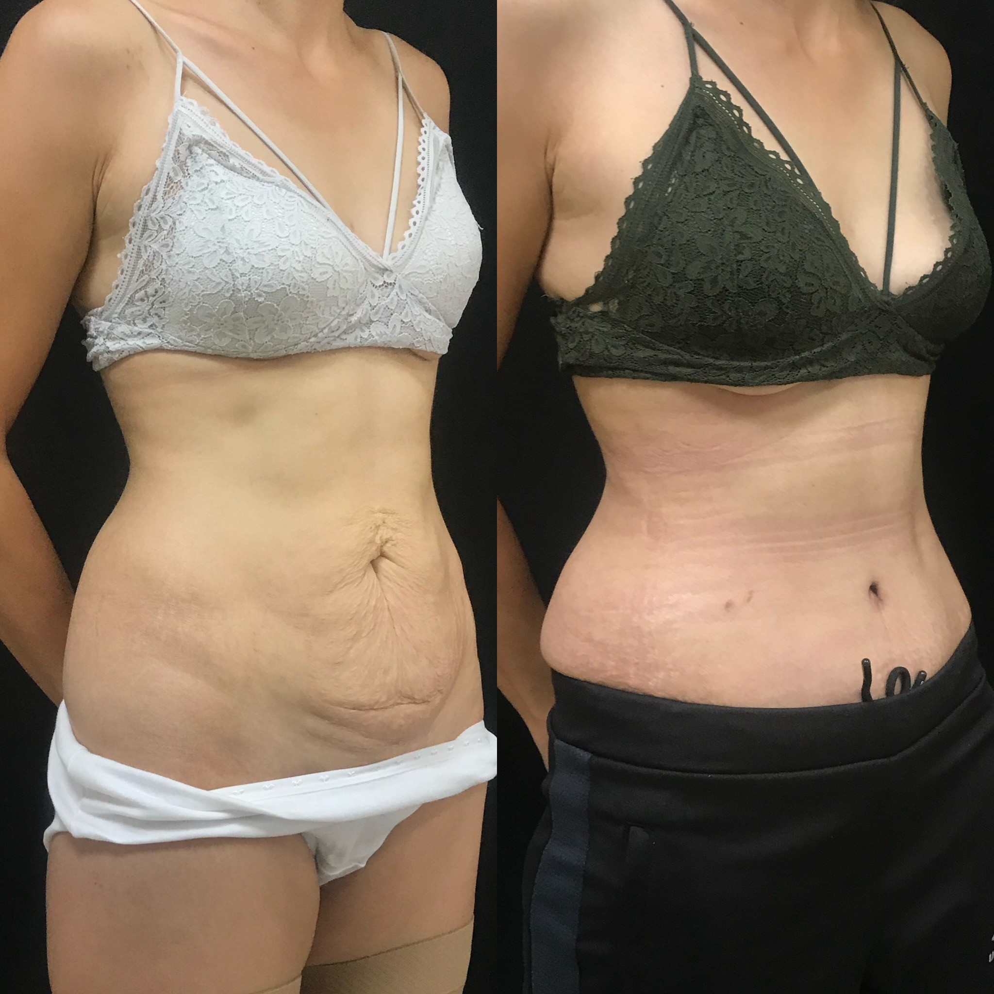 tummy tuck result before after 1 month post-op oblique view