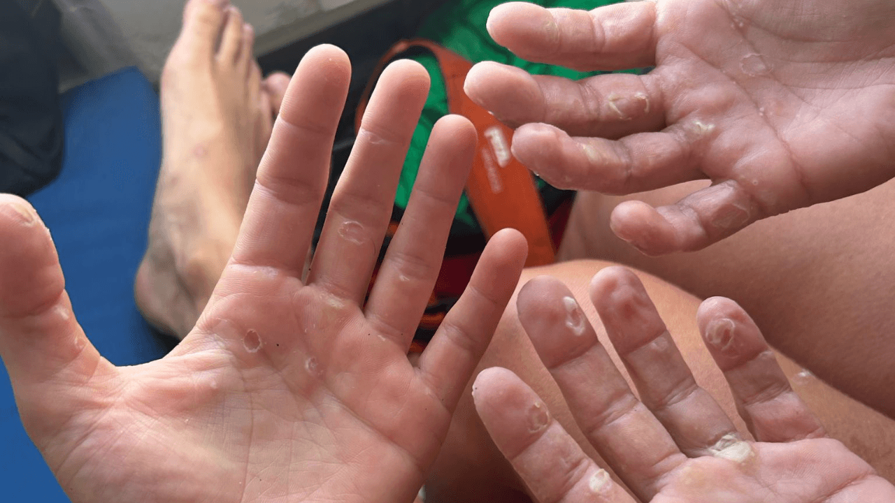 Miriam and Jess showing their hands full of blisters during their Pacific row