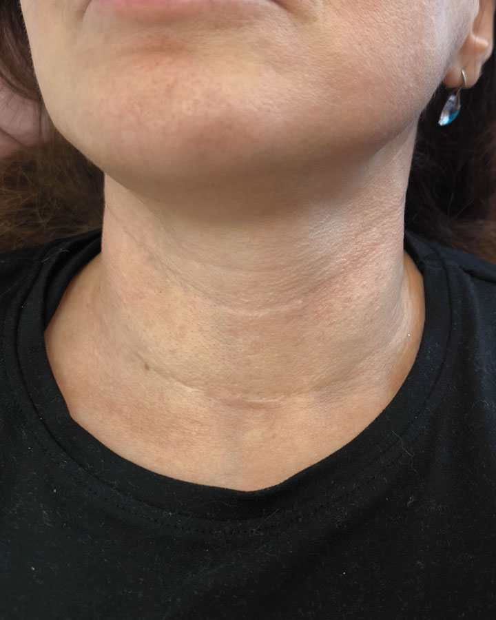 Detail pokožky krku s prejavmi ochabnutia pred estetickým zákrokom