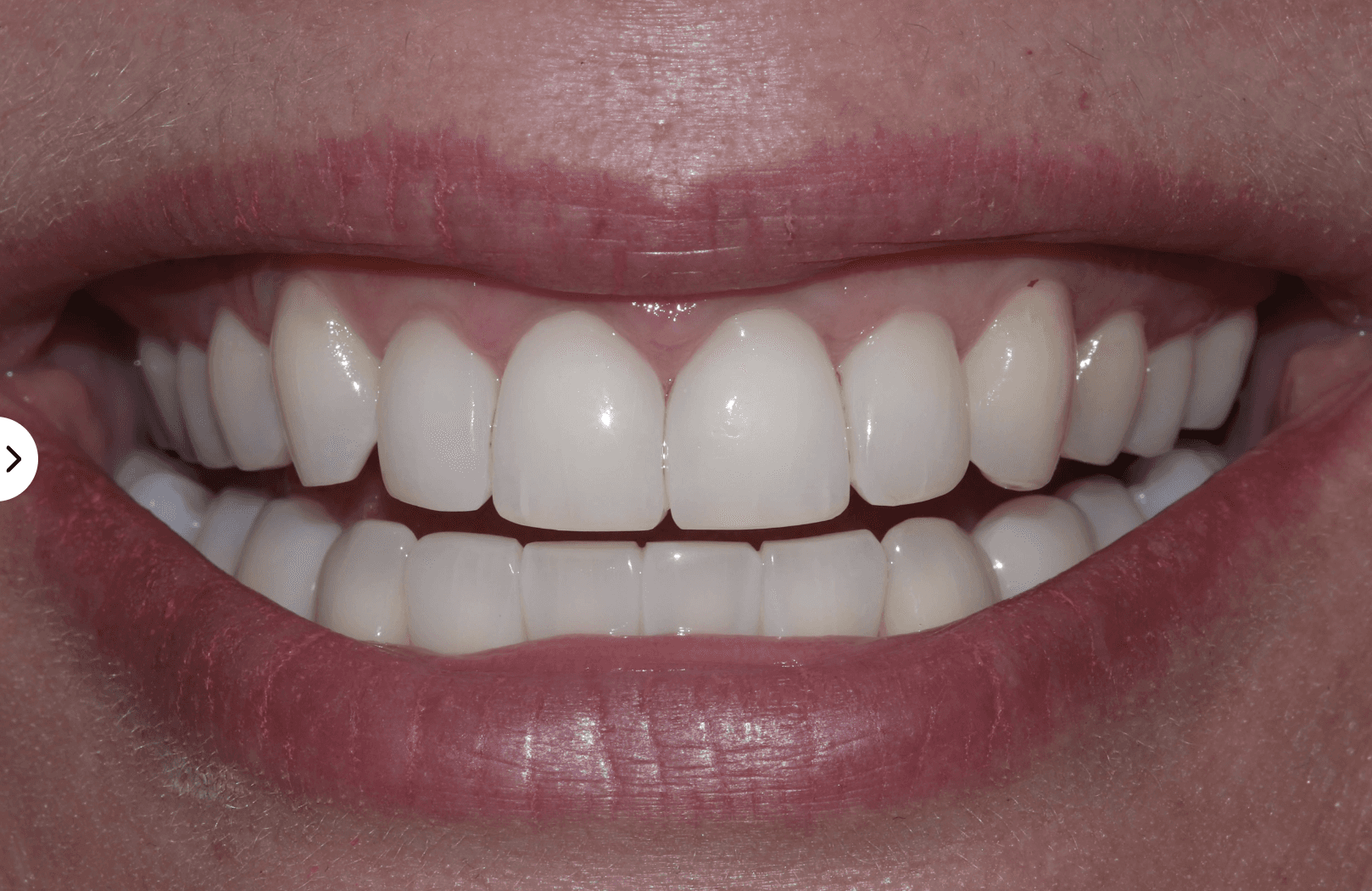 Filled in full smile after Bioclear treatment