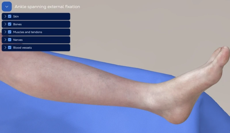 Ankle Spanning External Fixation