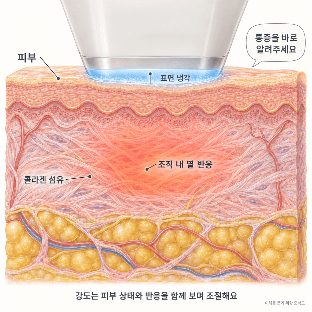 표면 냉각과 조직 내 고주파 열 반응을 구분해 보여주는 모식도