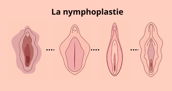 illustration d'une La nymphoplastie