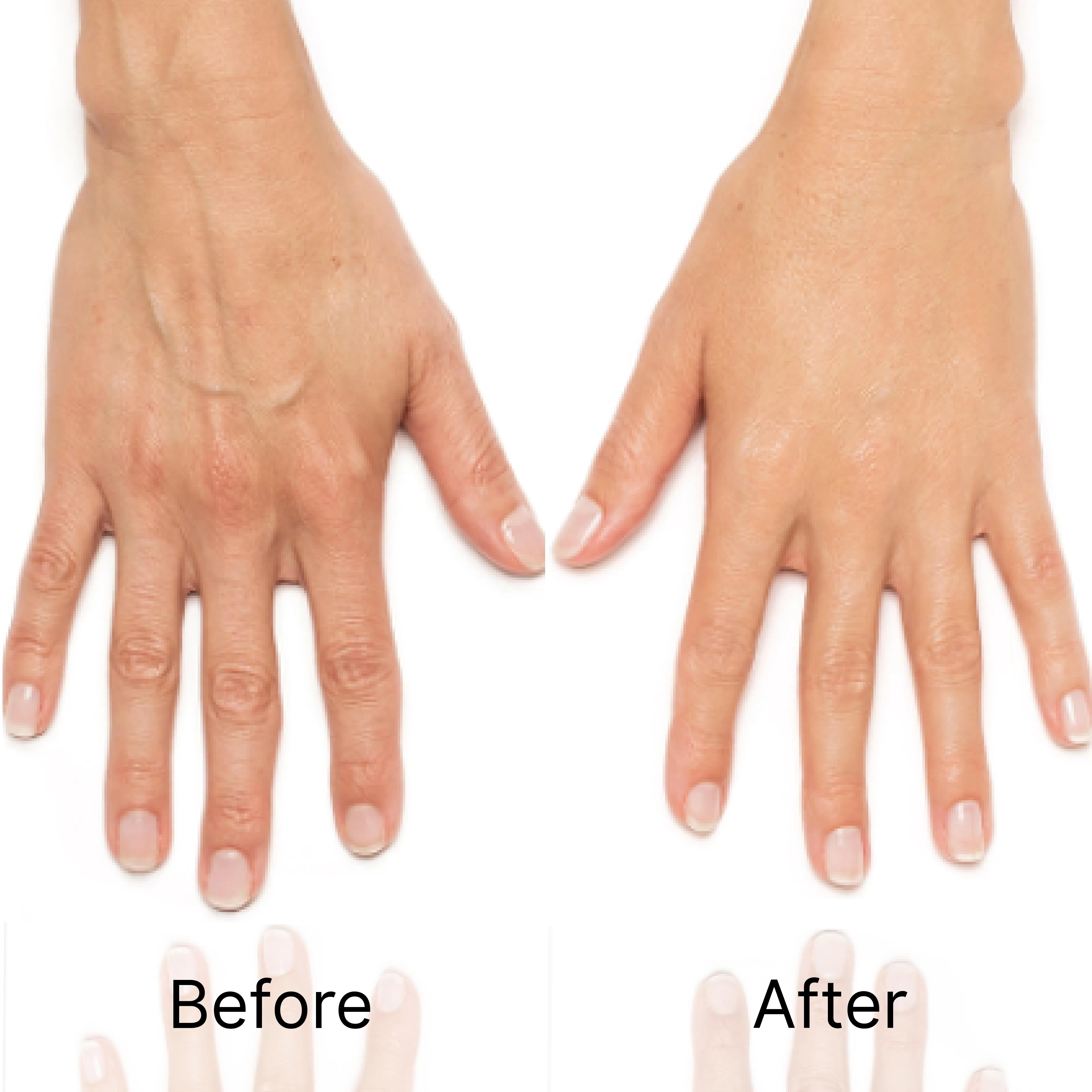 Aowita Leading Manufacturer of Aesthetic Products Before and After Pictures of Hand Treatment