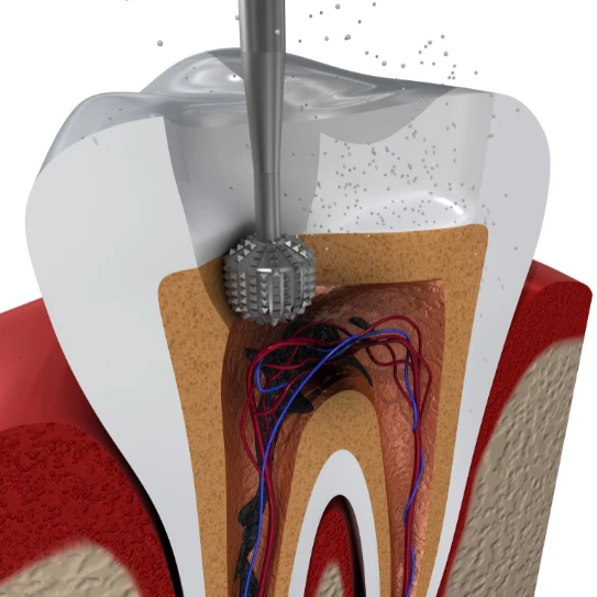 root canal cost