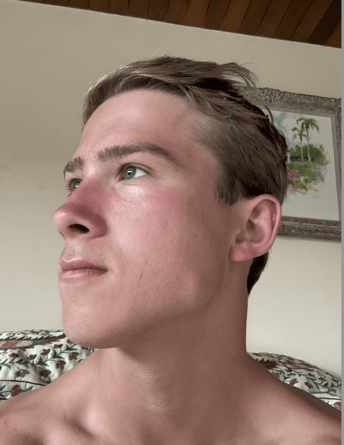After dealing with acne