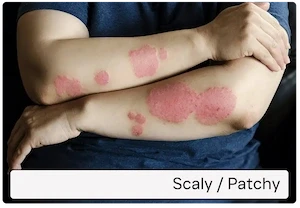 Scaly / patchy