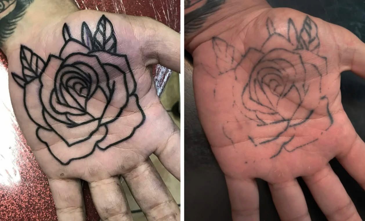 Hand Tattoo Removal