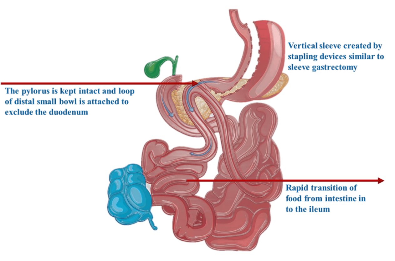 SIPS Surgery | Dr Aloy Mukherjee