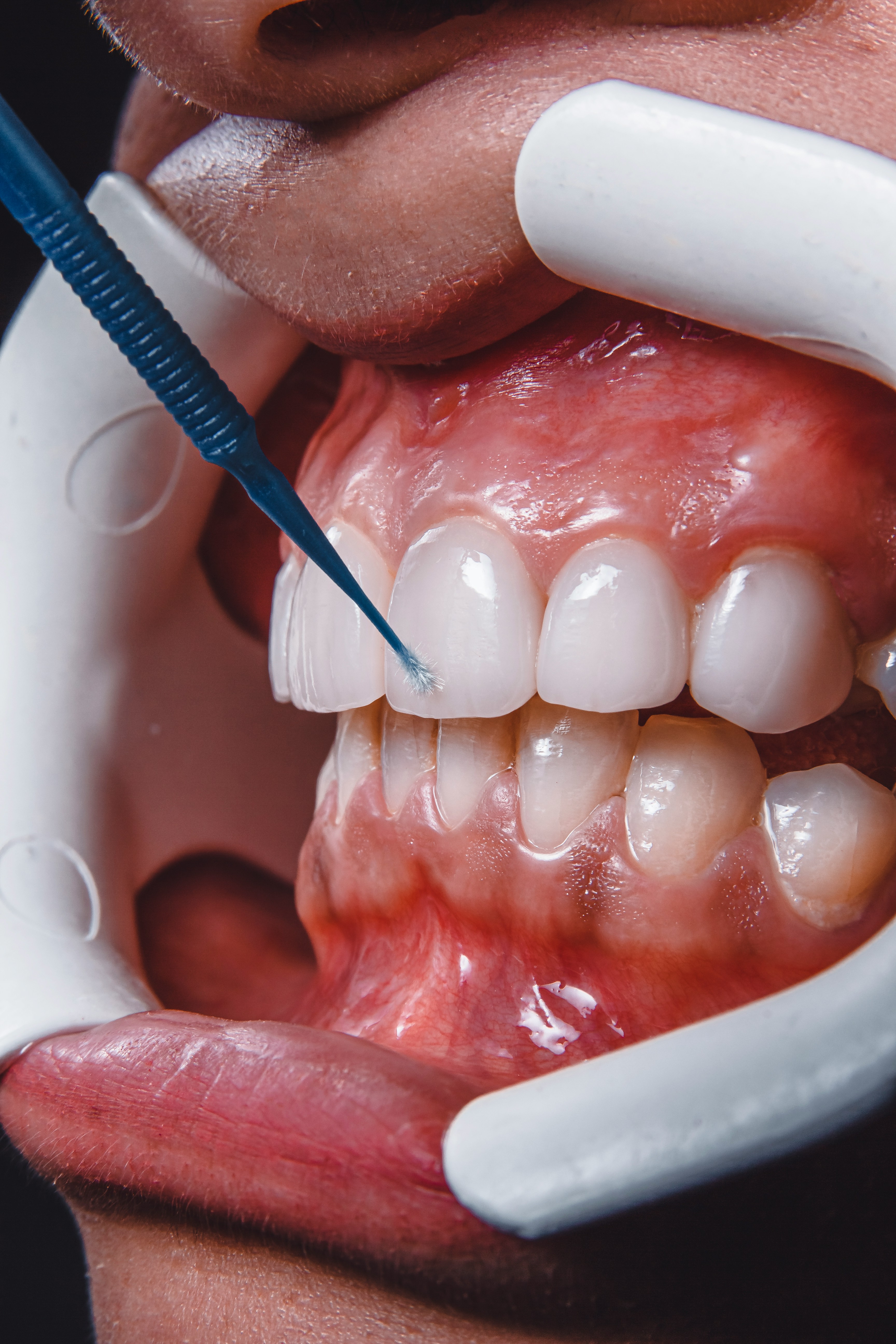 Before treatment: crooked, overlapping front teeth, unretouched