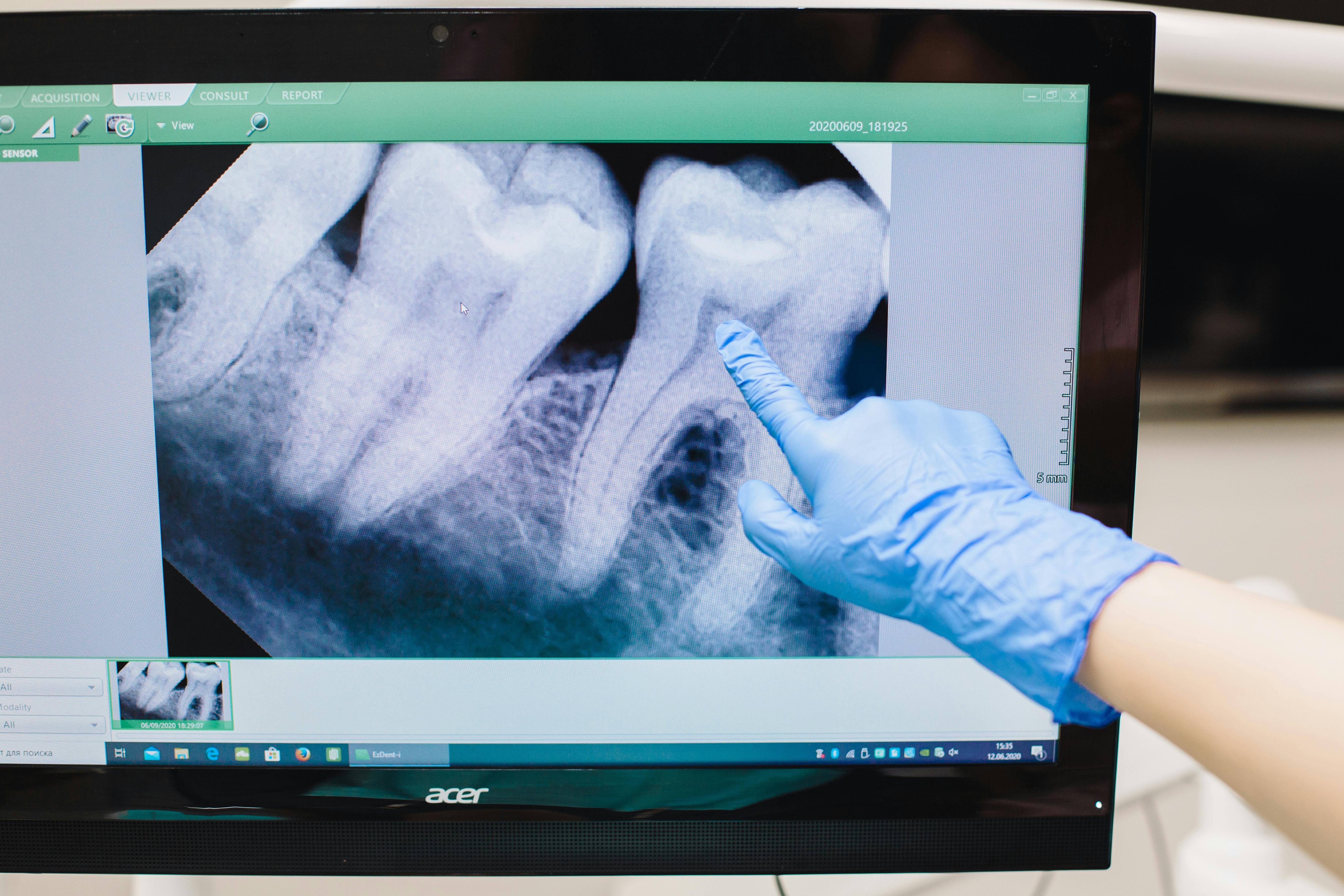 Dentist looking at teeth xray on screen