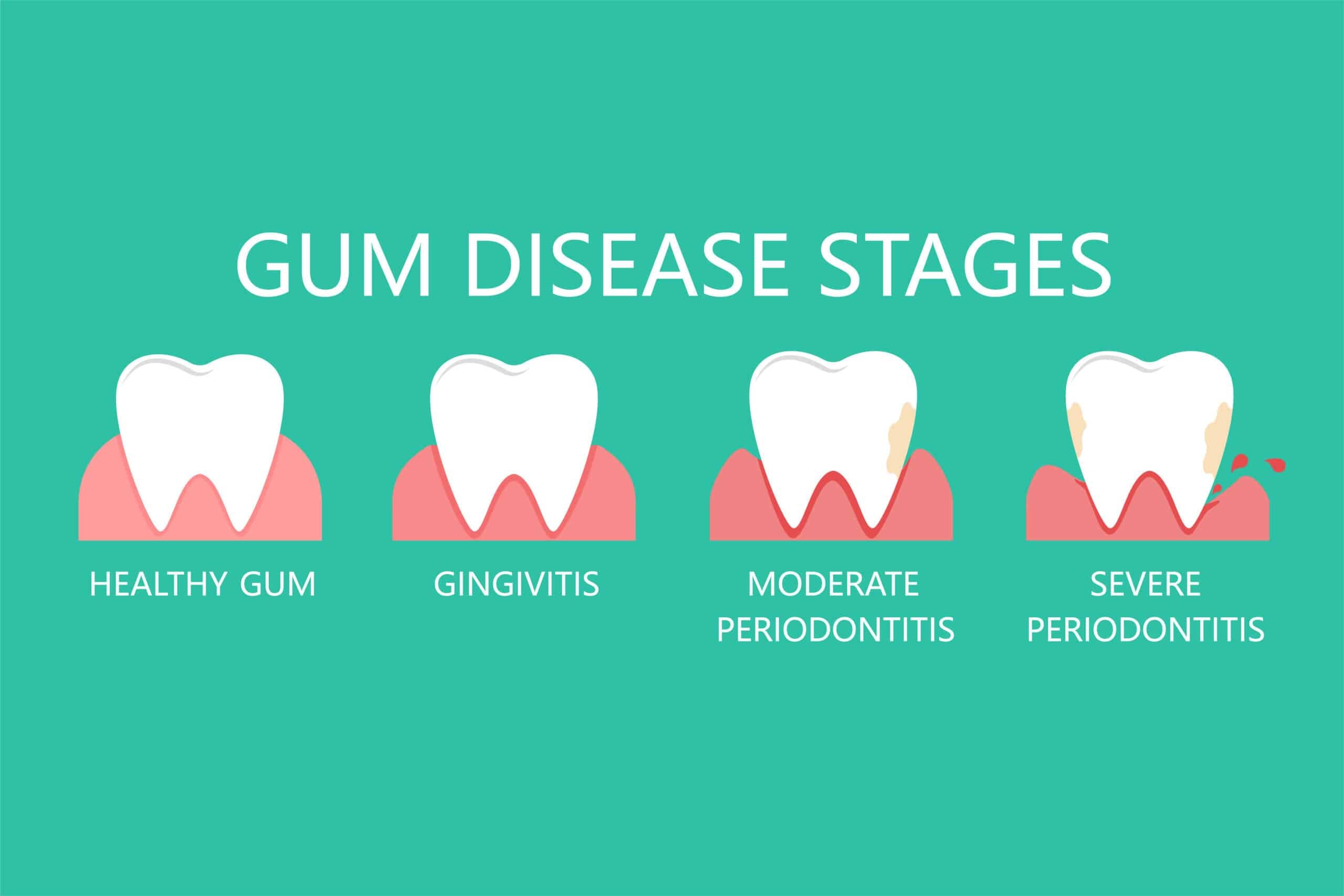 gum disease periodontal stages from healthy to severe