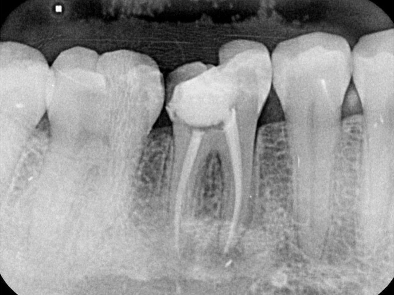 The Benefits of Chemical Peels