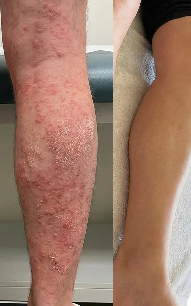 Before and after treatment - arm