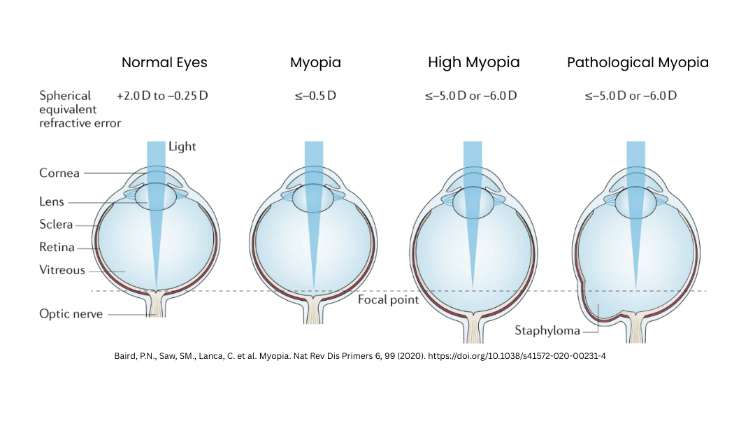 myopic eyes