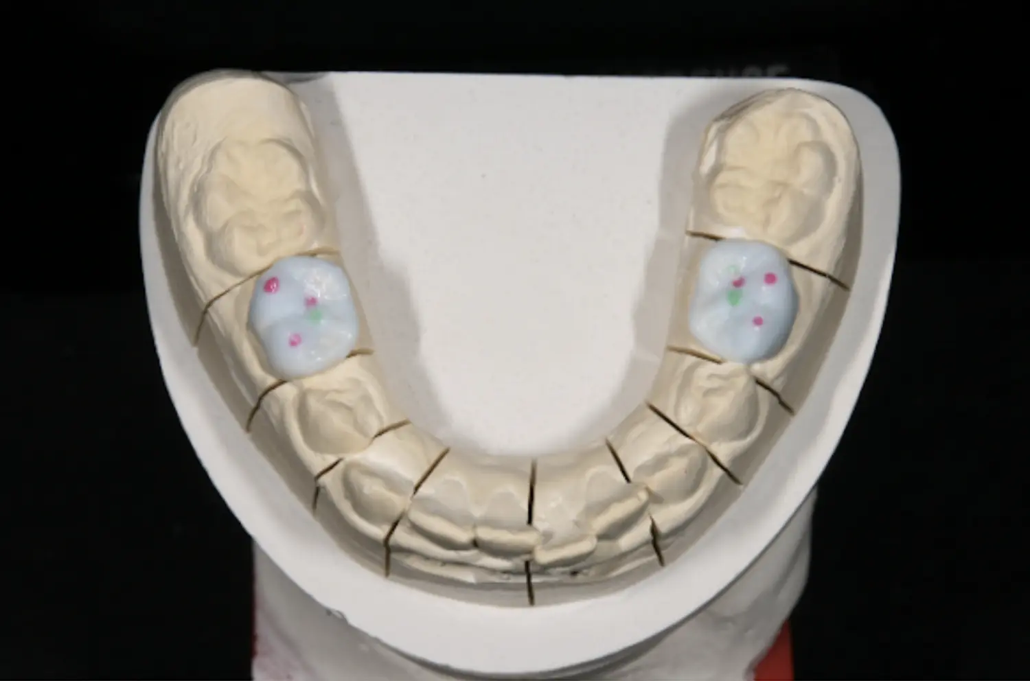 Wax-up-Entwurf der zukünftigen Onlays mit einem speziellen Mechanismus, der den Unterkiefer in eine  grundlegend bessere physiologische Position bringt. Dieser Ansatz entlastet die Kiefergelenke (TMJs)  und fördert ein gesundes Wachstum der Kiefer sowie der Gesichts- und Schädelknochen.