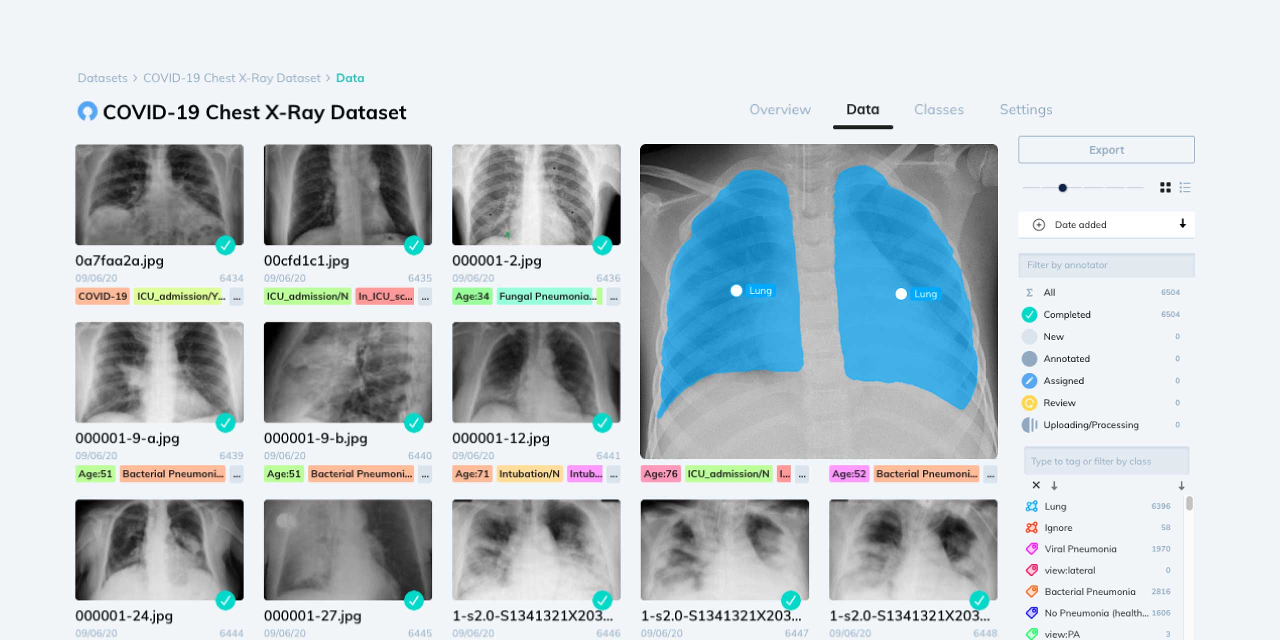 X Ray dataset in V7 Darwin