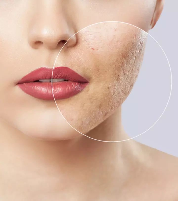 Acne & Scar Treatment in Hurghada - Sun Clinics
