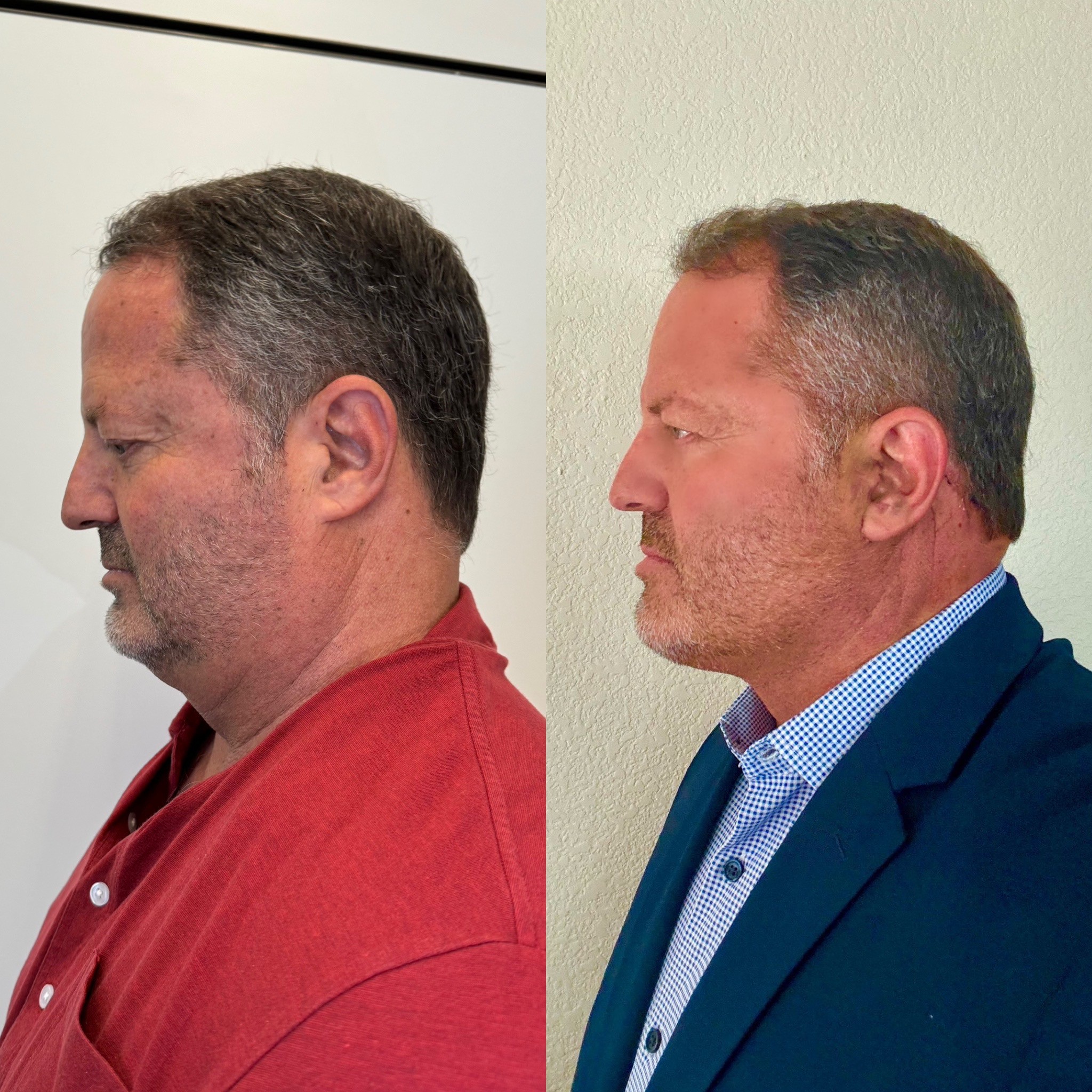 neck lift for turkey neck deformity before after left side view