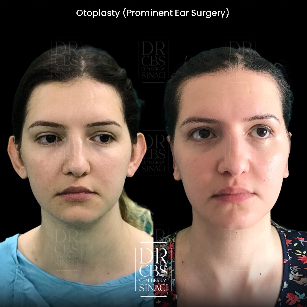 2 weeks otoplasty result