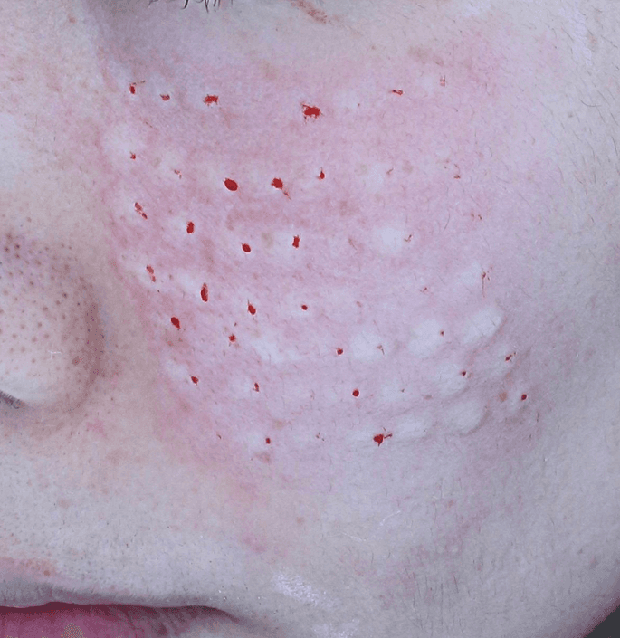 리쥬란1cc시술후사진