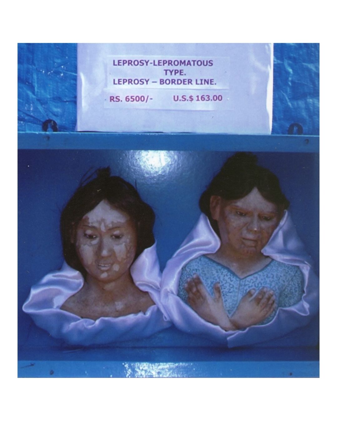 Leprosy (Lepromatous & Borderline) Dual Model