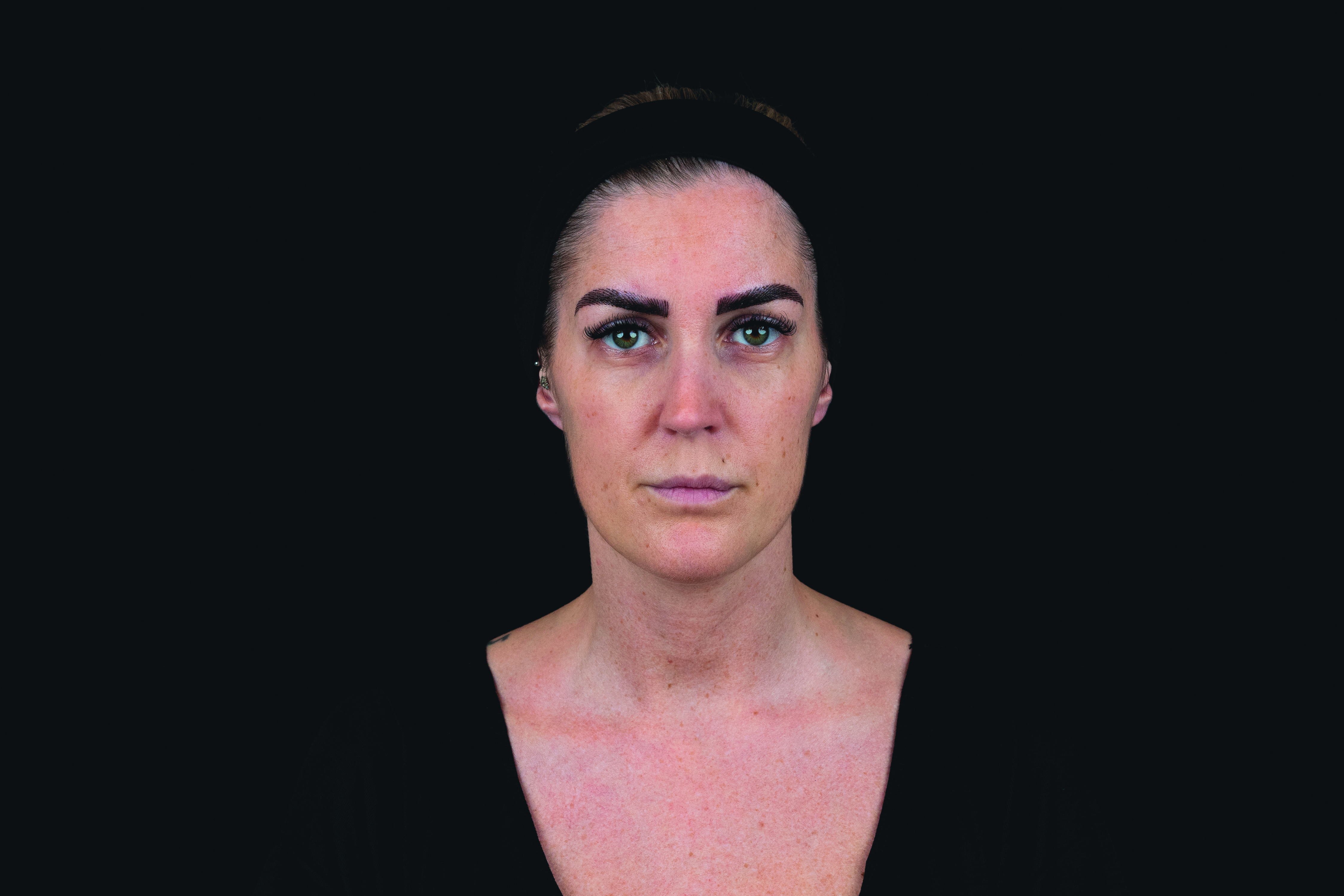 Before treatment frontal view of female patient prior to Croma Saypha Volume Plus Lidocaine dermal filler application