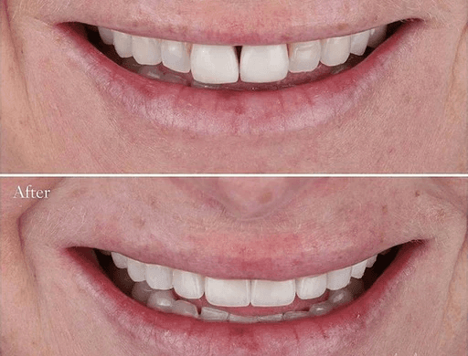 Before and after composite veneers showing improved teeth shape and brightness.