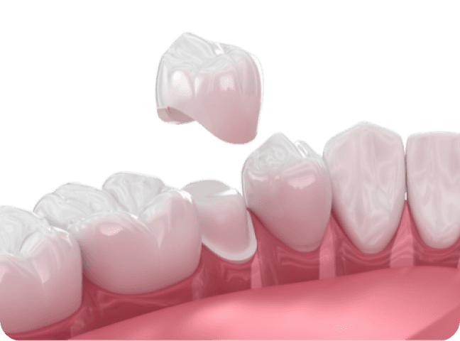 3D model of dental crowns
